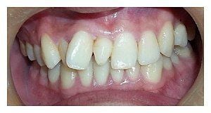 Hyperdontia – tình trạng bất thường của hàm răng