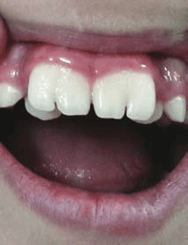 Tình trạng răng sinh đôi – Tooth Gemination