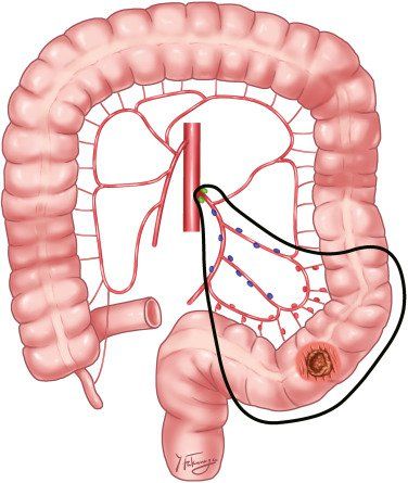 
Vị trí đại tràng sigma
