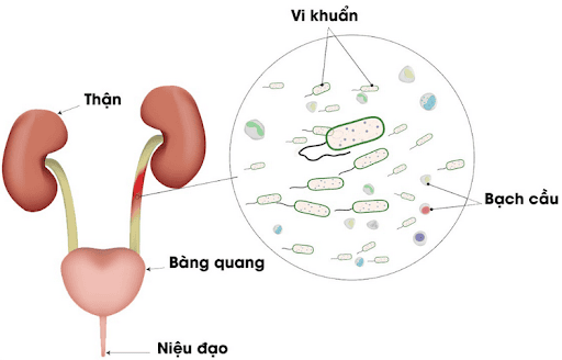 5 cách chữa viêm đường tiết niệu tại nhà hiệu quả