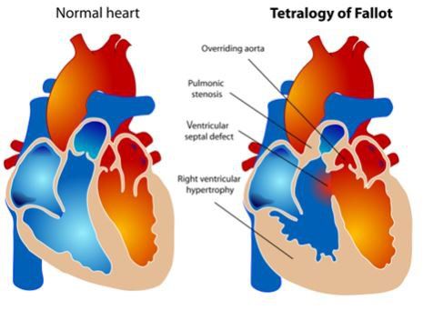 
Tứ chứng Fallot là hội chứng tim bẩm sinh phức tạp và phổ biến nhất (Nguồn ảnh: Wikipedia)
