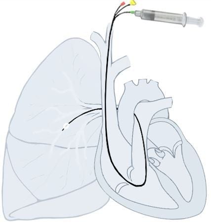 Thông tim và những điều cần biết: Rủi ro, biến chứng