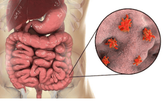 Khó khăn trong việc phân biệt giữa bệnh amip đường ruột và bệnh viêm ruột IBD