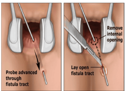 Phẫu thuật cắt mô xơ đường rò hậu môn 
