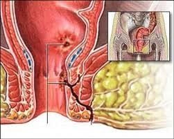 Điều trị nội khoa trong bệnh Crohn có rò hậu môn