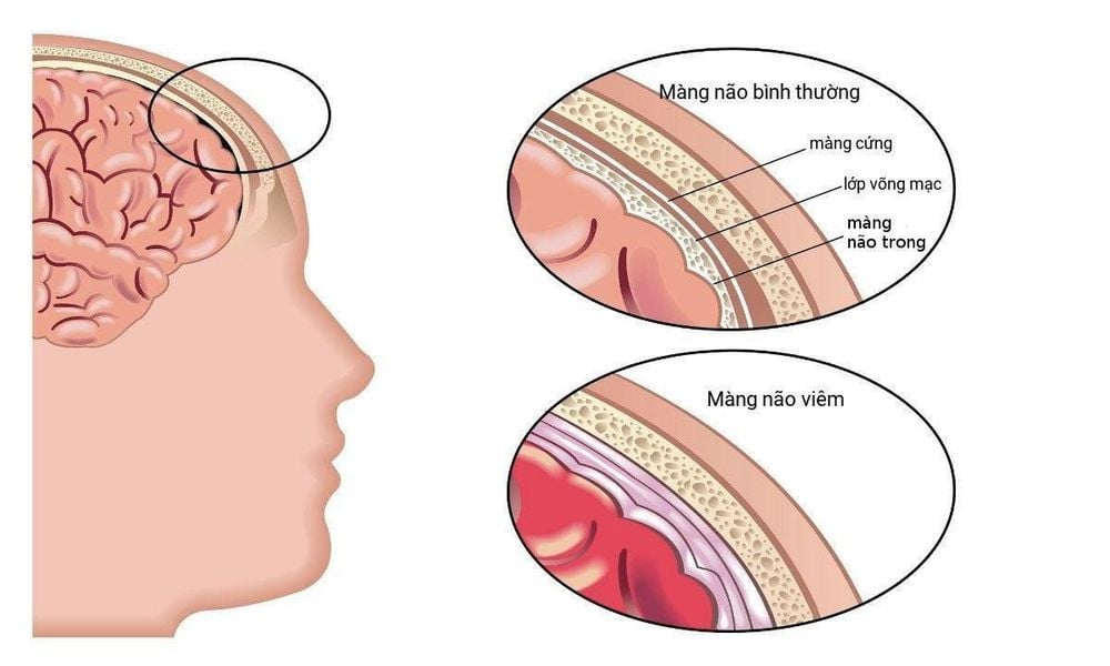 
Tiêm phòng vắc-xin phế cầu khuẩn Synflorix giúp phòng bệnh viêm màng não do khuẩn phế cầu gây ra
