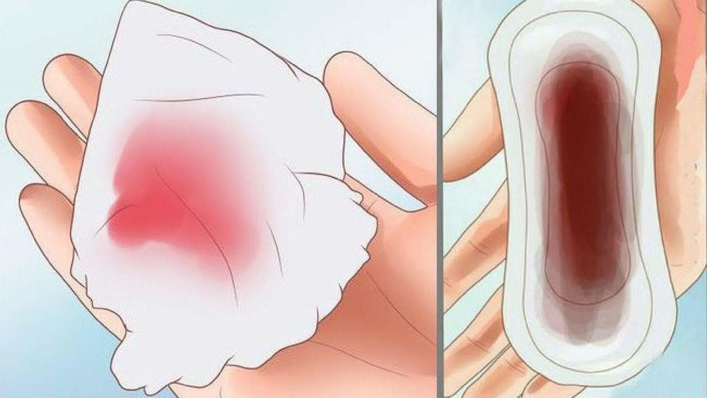 
Polyp tử cung gây chảy máu âm đạo sau mãn kinh
