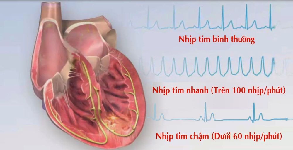 
Tim đập nhanh làm nặng hơn tình trạng thiếu máu cơ tim
