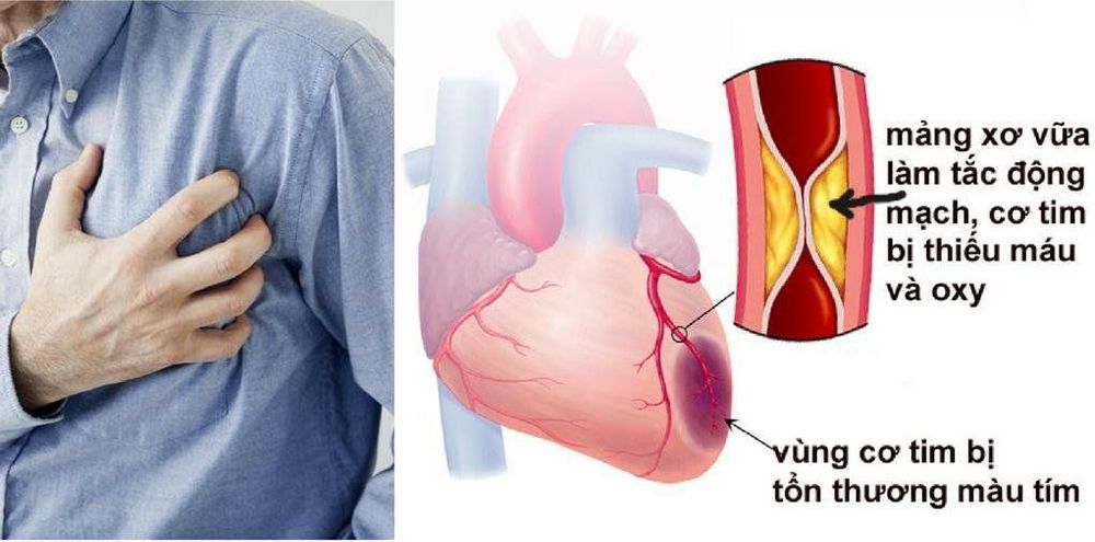 Bệnh lý mạch vành là một trong những nguyên nhân gây tử vong ở những người mắc bệnh tim mạch