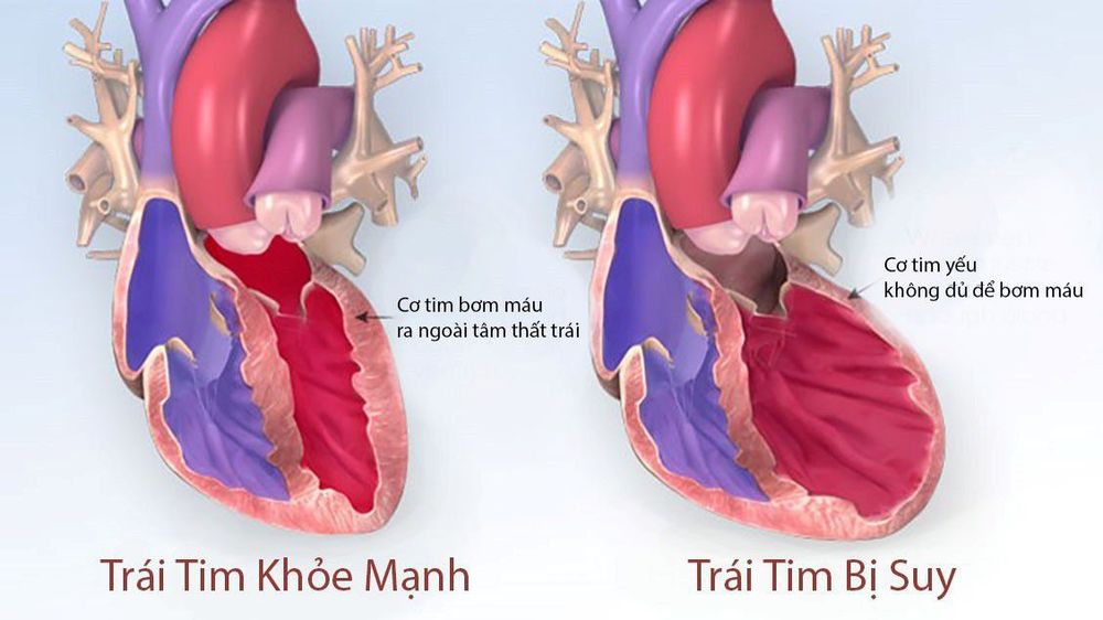 
Giai đoạn suy tim
