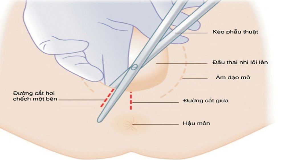 
Rạch tầng sinh môn giúp chuyển dạ dễ dàng hơn
