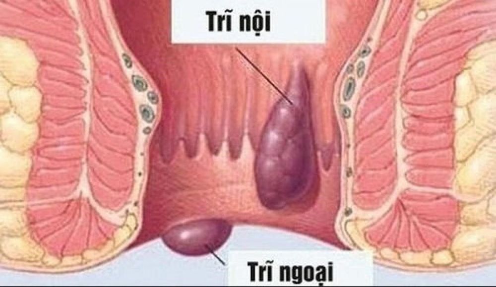 Bệnh trĩ cũng gây đau đớn và ngứa rát hậu môn vô cùng
