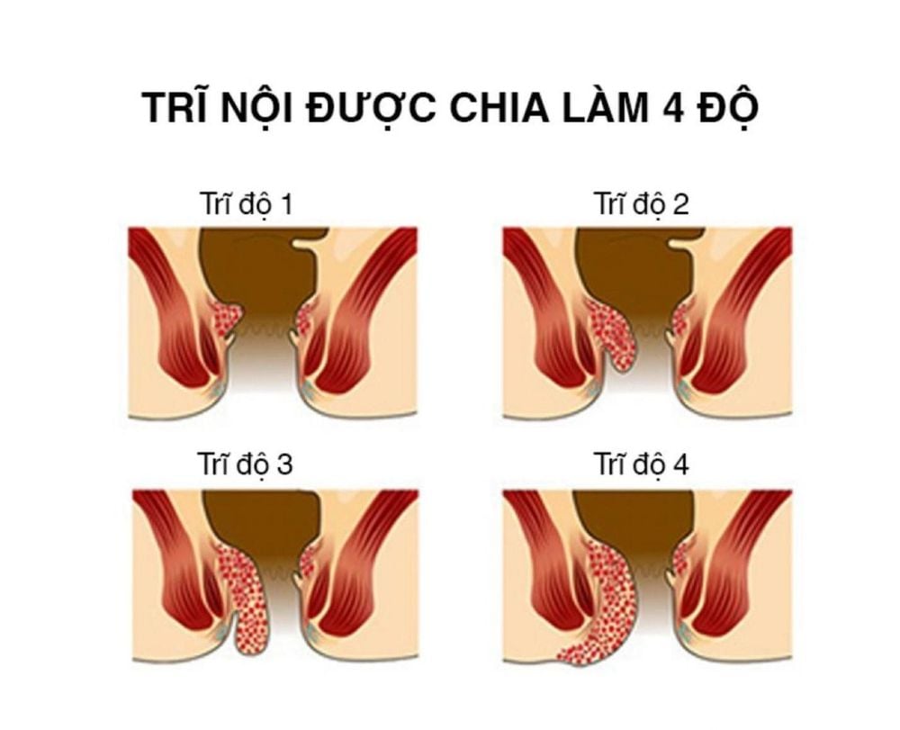 
Trĩ nội xuất hiện và phát triển rất âm thầm bên trong hậu môn, nên rất khó phát hiện ra bệnh
