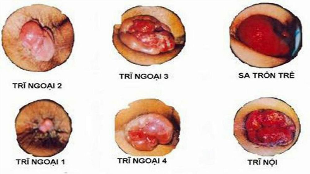 Coi chừng trẻ em cũng có thể mắc bệnh trĩ