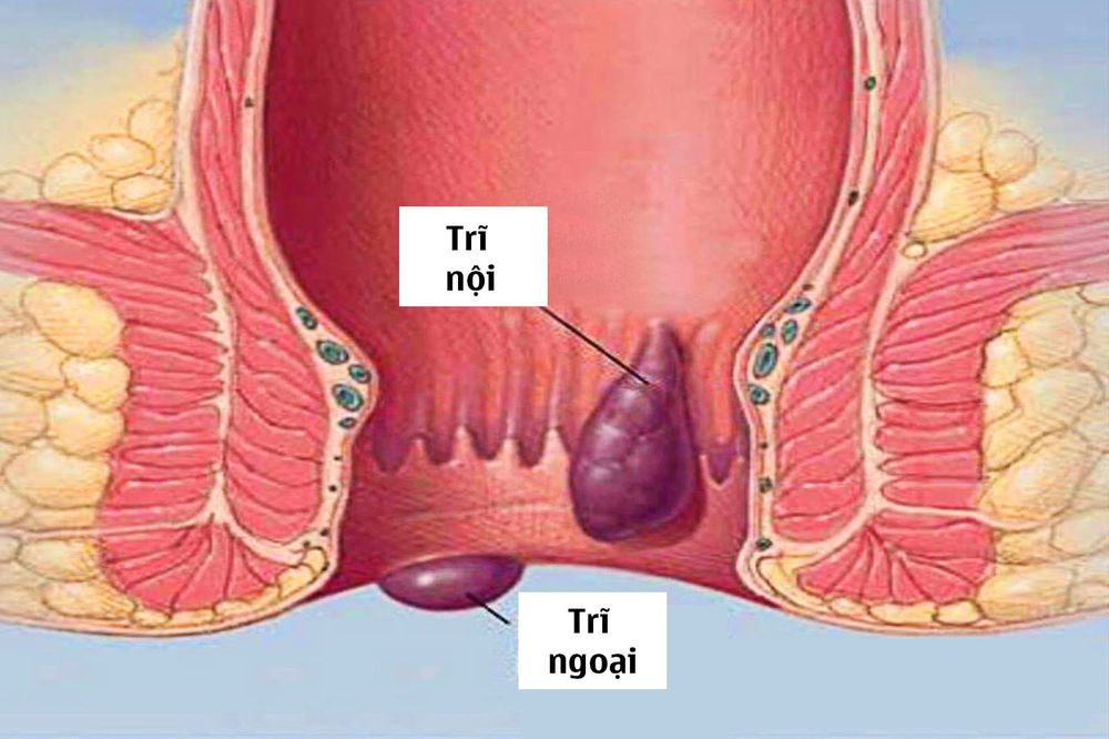 
Trĩ hỗn hợp là một loại của bệnh trĩ. Đây là sự kết hợp của trĩ nội và trĩ ngoại.
