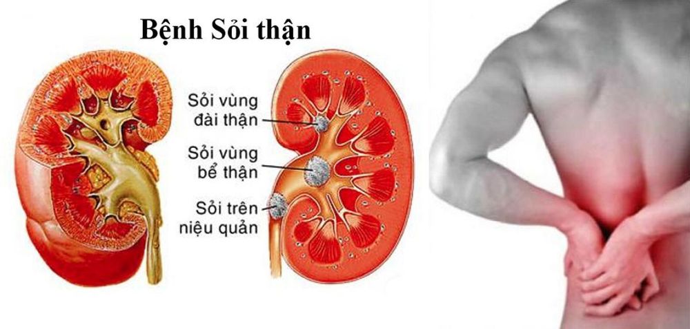 How are kidney stones formed?