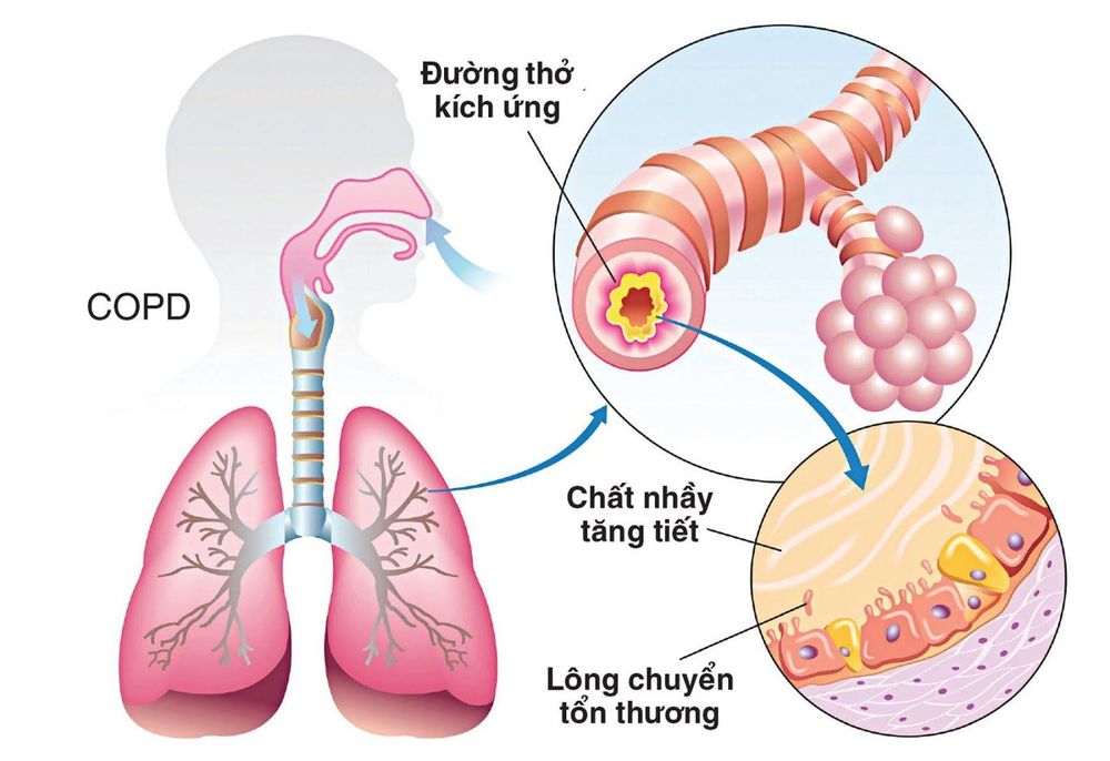 
Phổi tắc nghẽn mãn tính là tình trạng viêm niêm mạc đường thở mãn tính
