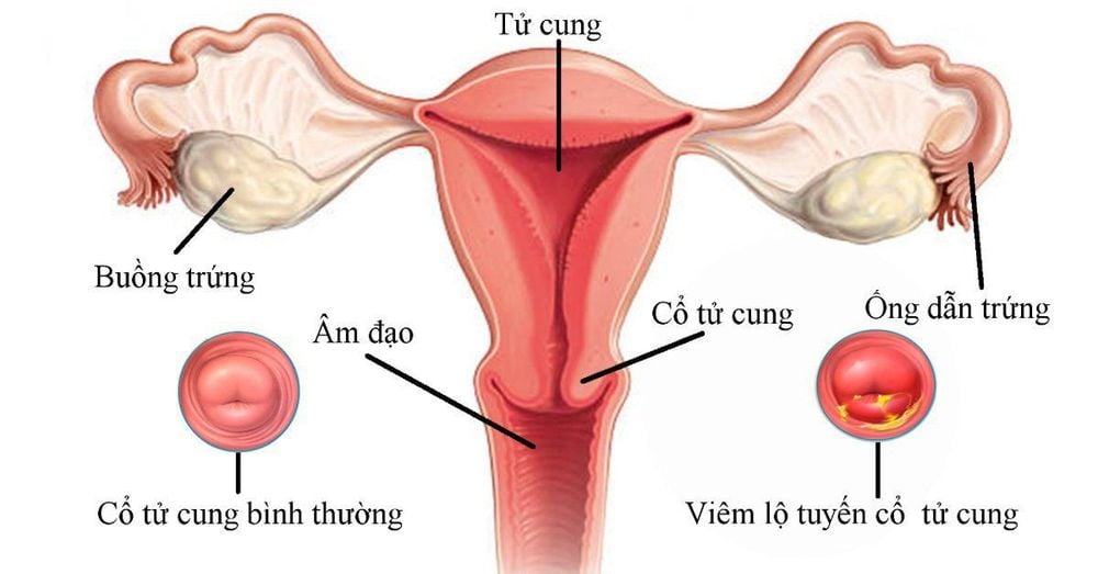 
Cấu tạo tử cung
