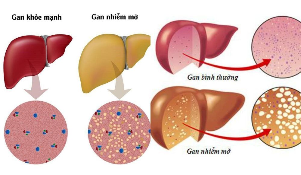 
Các bệnh về gan khuyến khích xét nghiệm chức năng gan
