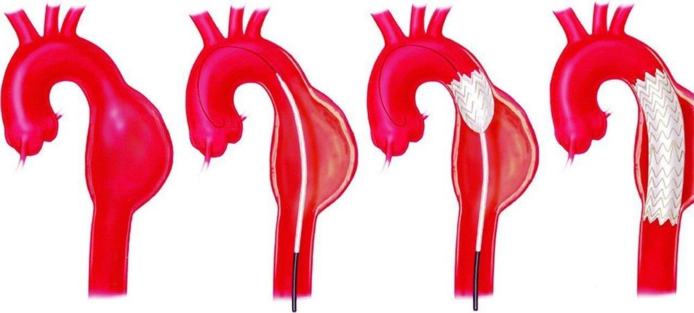 
Phình tách động mạch chủ là một trong những nguyên nhân gây đau đầu quanh hốc mắt
