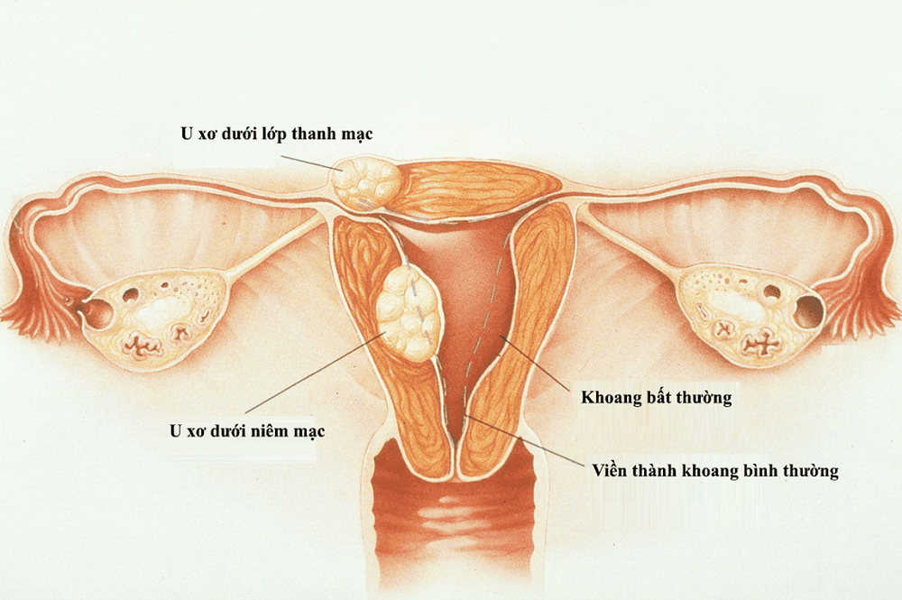 
U xơ tử cung có nên mổ tùy thuộc vào vị trí của khối u.
