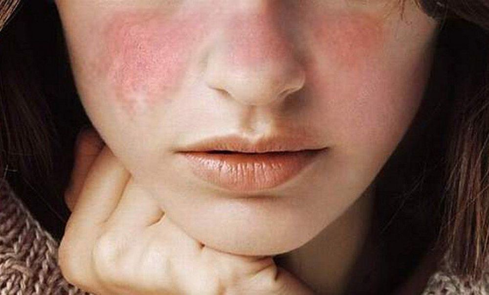 
Lupus ban đỏ ở mức độ nhẹ chỉ gây ra các phát ban trên da
