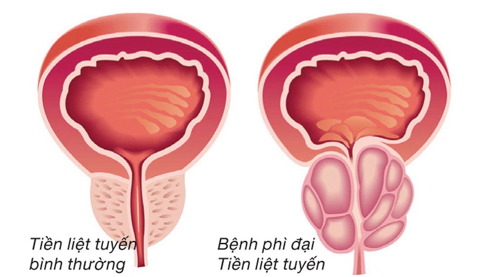 
U phì đại tuyến tiền liệt do sự gia tăng kích thước tuyến tiền liệt ở nam giới
