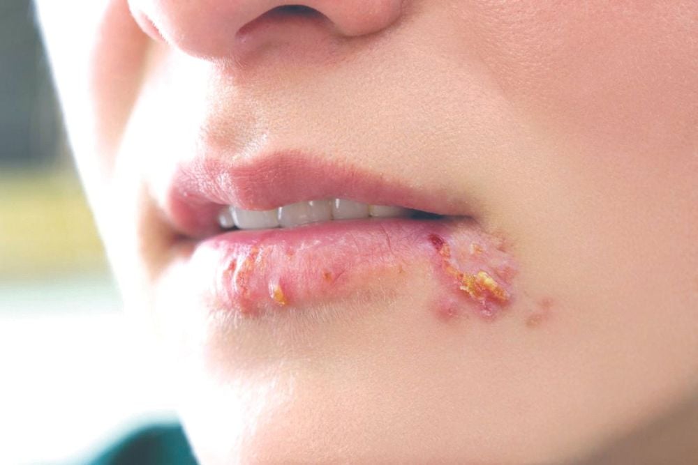 Genital herpes typically develops into round blisters that form in clusters and are uniform in appearance.