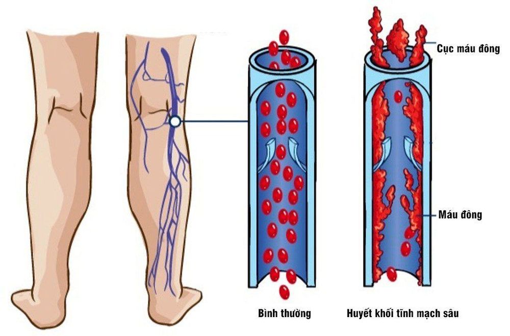 
Các cục máu đông thường gặp nhất là ở chân
