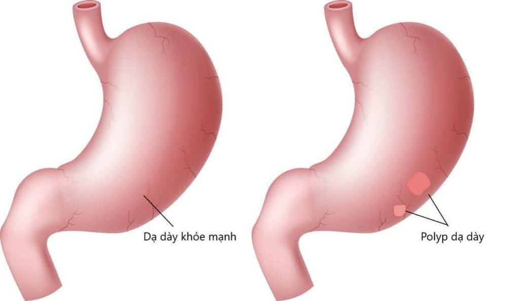 
Polyp dạ dày có thể hóa ác tính thành ung thư dạ dày
