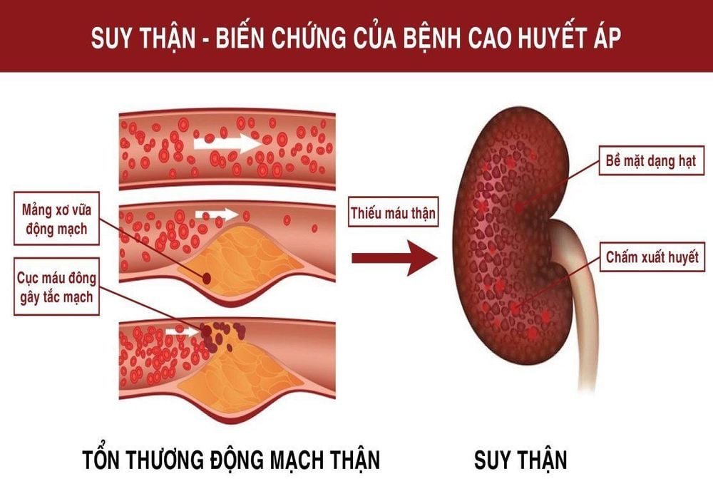 
Tăng huyết áp lâu dài có thể dẫn đến suy thận mạn
