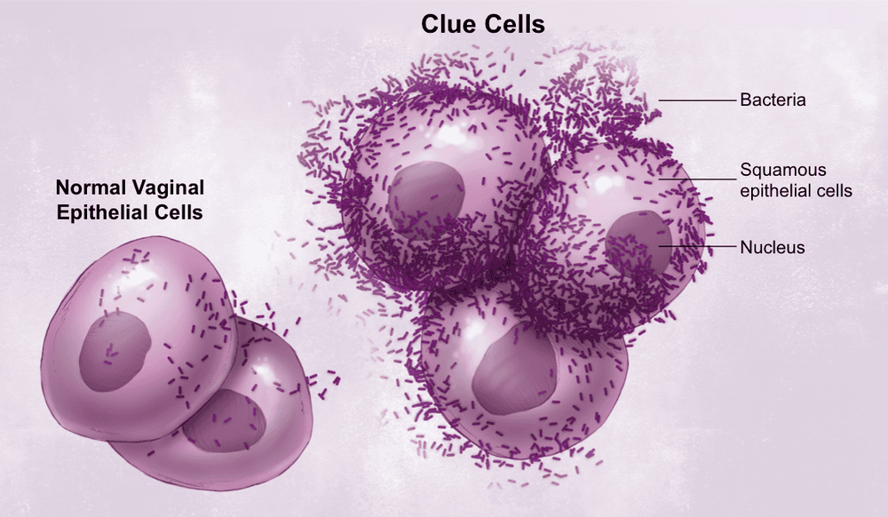 
Vi khuẩn Bacterial Vaginosis gây viêm phụ khoa
