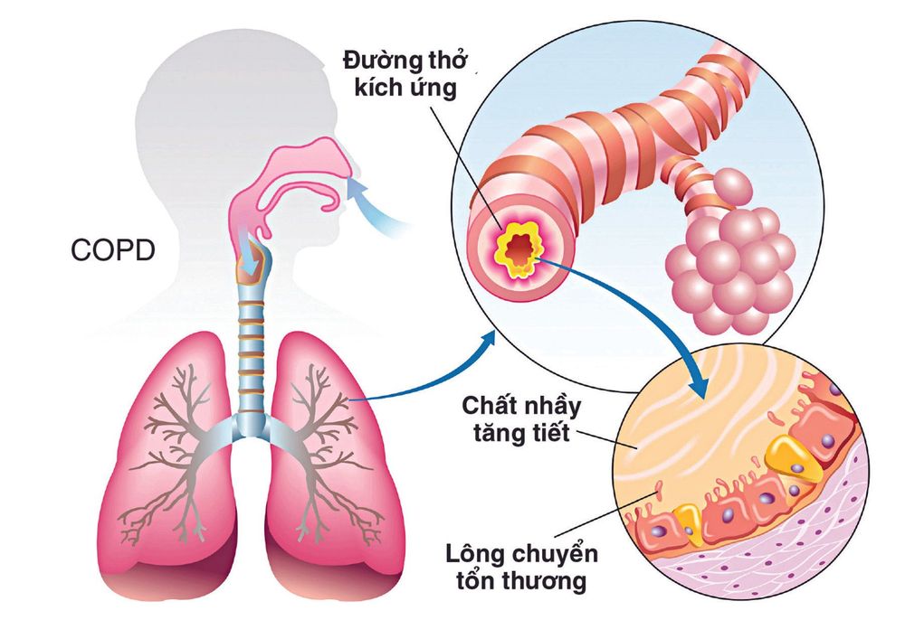 
Người hút thuốc có tỉ lệ tử vong do bệnh phổi tắc nghẽn mạn tính cao gấp 10 lần so với người không hút thuốc.
