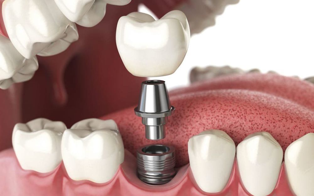 
Implant là giải pháp phục hình răng đã mất được đánh giá tốt hiện nay
