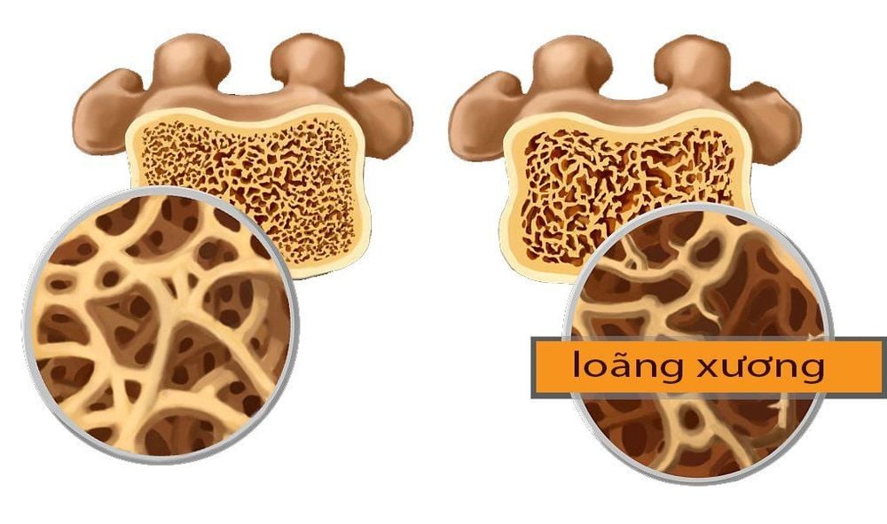 
Triệu chứng loãng xương cảnh báo nguy cơ mắc hội chứng cushing
