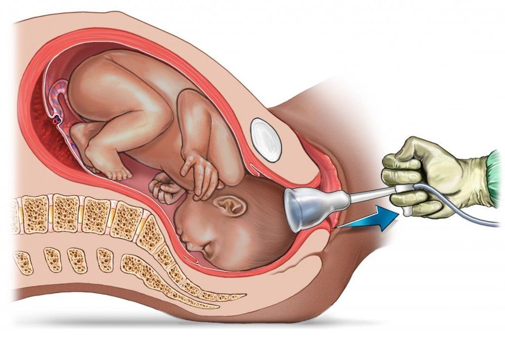 
Sinh con với sự hỗ trợ của giác hút sản khoa
