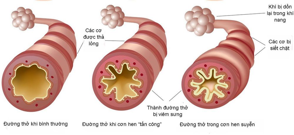 
Mẹ bầu có thể bị co thắt phế quản sau phẫu thuật
