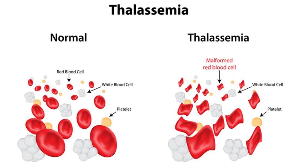 
Thiếu máu kéo dài là triệu chứng phổ biến của sản phụ mắc bệnh Thalassemia
