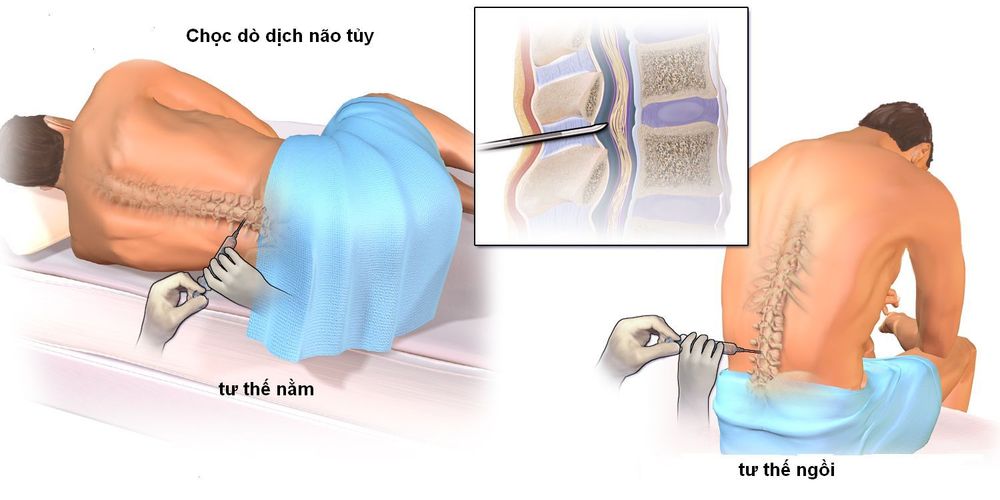 
Hình ảnh chọc dịch xét nghiệm dịch não tủy
