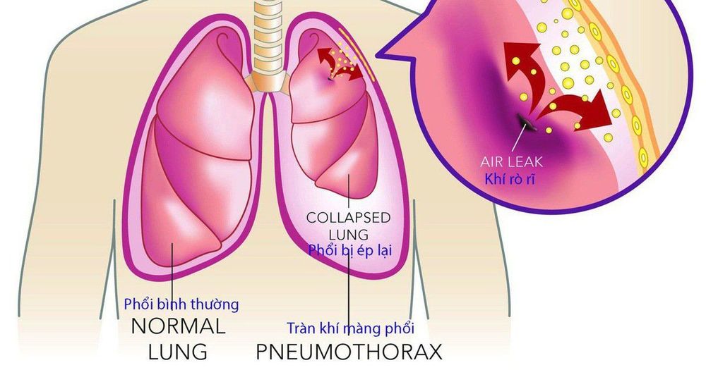 
Các bệnh về phổi ảnh hưởng đến màng phổi
