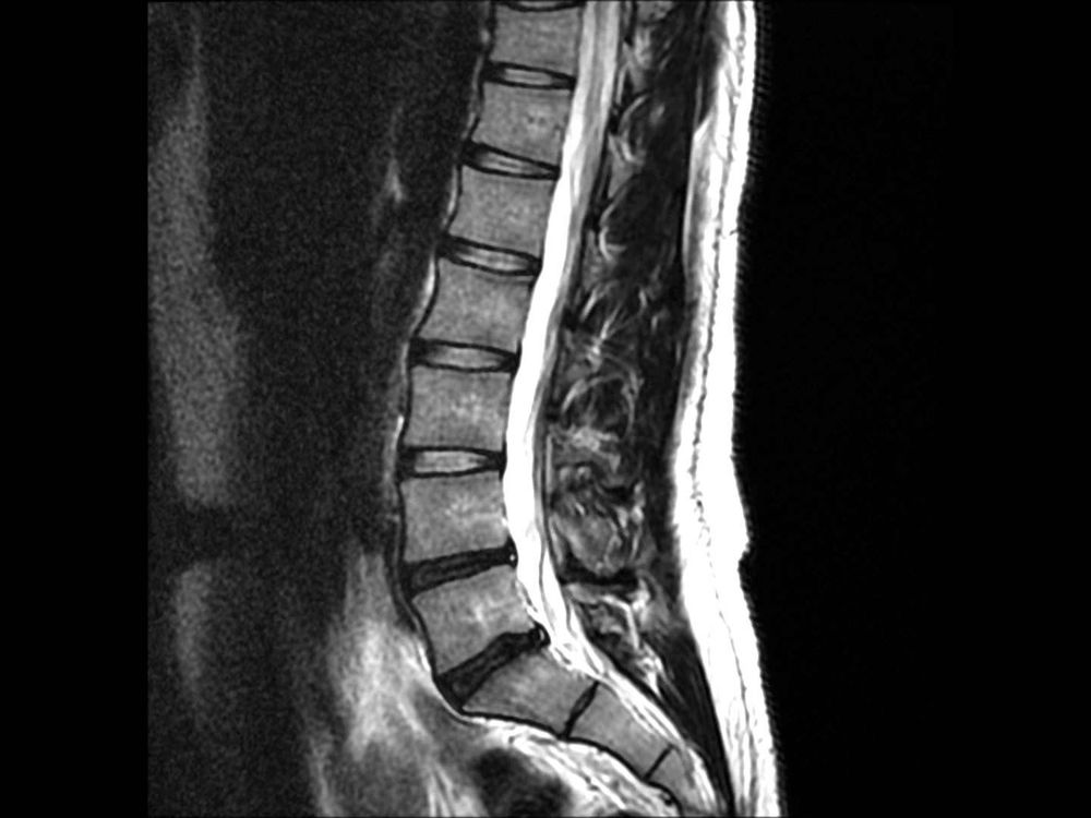 
Hình cộng hưởng từ (MRI) thoát vị đĩa đệm cột sống thắt lưng
