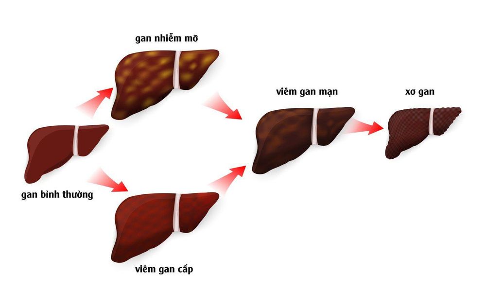 
Làm thế nào để xác định gan bị xơ hóa?
