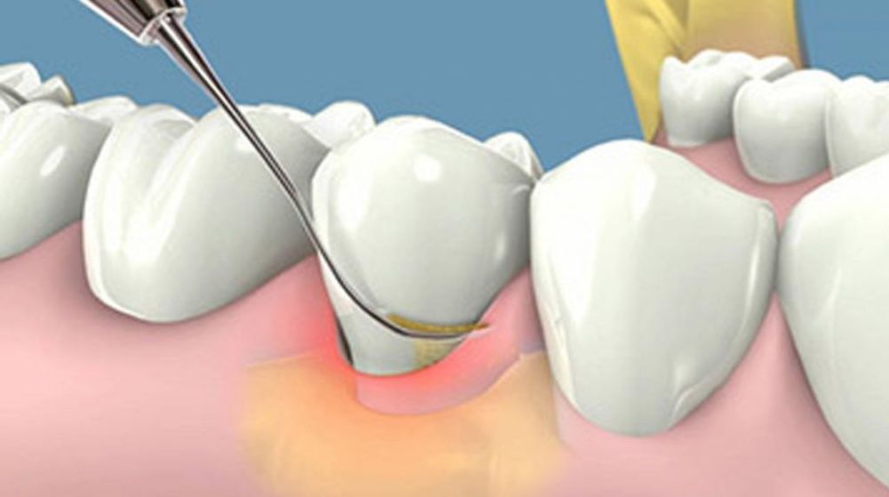 
Đối với trẻ em cũng cần được thực hiện lấy cao răng
