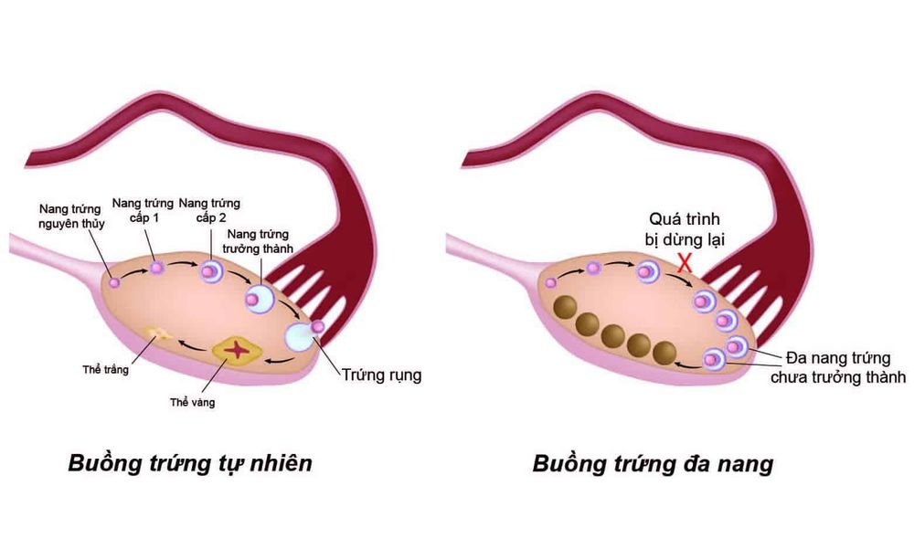 
Siêu âm buồng trứng để chẩn đoán buồng trứng đa nang
