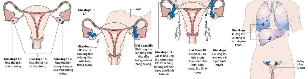 
Giai đoạn 3 ung thư buồng trứng đánh dấu hiện tượng di căn tế bào ung thư
