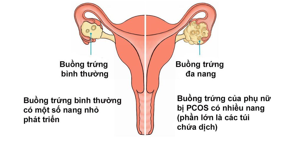 
Triệu chứng của u nang buồng trứng
