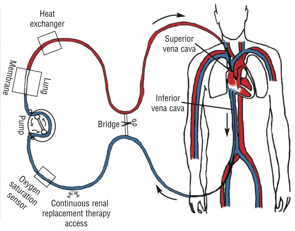 
ECMO là phương pháp oxy hóa qua màng ngoài cơ thể
