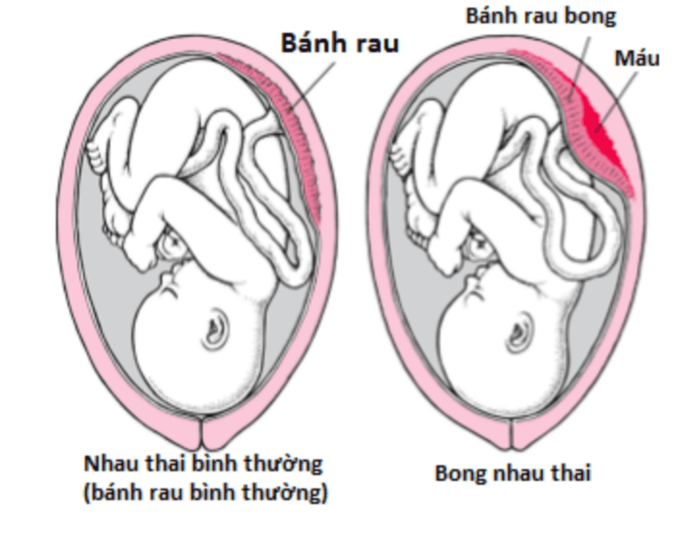 
Hình ảnh bong nhau thai
