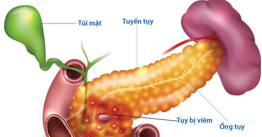 
Viêm tụy mạn tính
