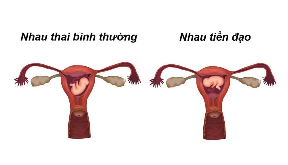 
Rau tiền đạo là một trong những nguyên nhân dễ bị sót nhau sau sinh
